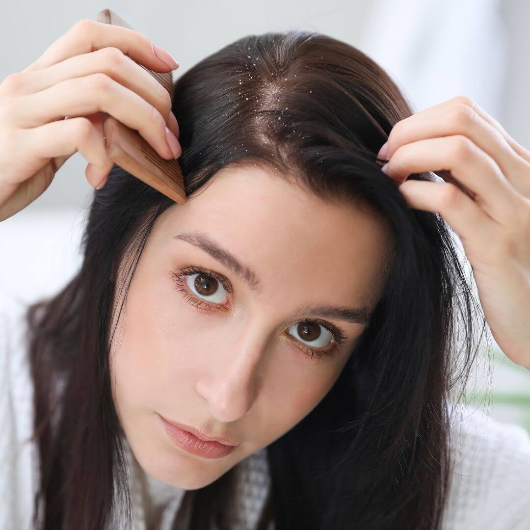 Natural ingredients in hair care to treat dandruff